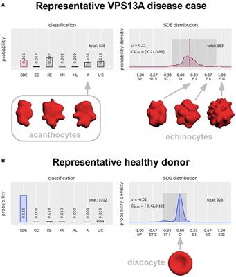 Commentary: Acanthocytes identified in Huntington's disease